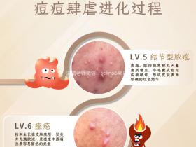 七老洪晴专业知识科普→痘痘痤疮严重程度怎么区分?