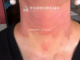 激素脸修护过程中脱皮怎么办?