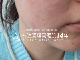 七老激素脸红烫痒疹子疙瘩修护案例