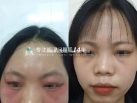 七老眼周反复过敏红肿痒修护案例