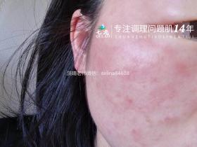 七老干红烫肿痒疹子疙瘩修护案例