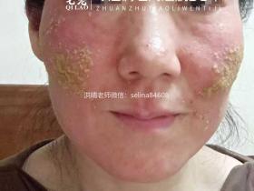 七老严重激素脸红肿烫痒疹子渗液结痂修护案例