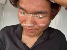 七老激素脸玫瑰痤疮脂溢性皮炎修护案例