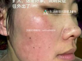 七老成片发红发烫大红脸修护案例