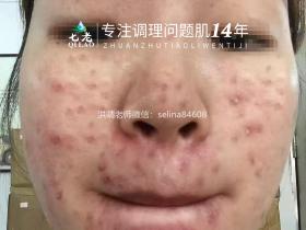 七老激素脸激素痘玫瑰痤疮皮炎修护案例