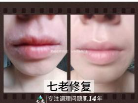 七老胶原水光修护口周皮炎反馈对比