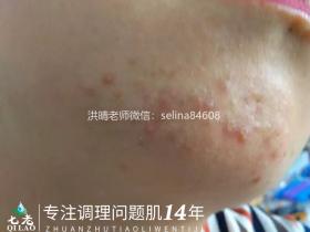 七老顽固粉刺痘痘修护案例