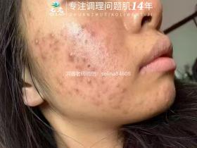 七老激素脸激素痘痘玫瑰皮修护案例