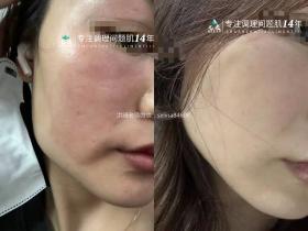 七老屏障受损红烫大红脸修护对比