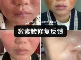 七老激素脸烂脸修护案例