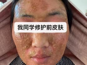 七老激素脸流黄水结痂修护案例