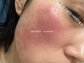 七老激素脸玫瑰神经性红烫大红脸修护案例