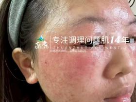 七老激素脸红肿痒疹子疙瘩修护案例