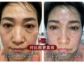 七老胶原水光