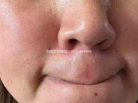 七老脂溢性皮炎泛红疹子干痒脱皮修护案例