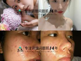 七老亲润安肤精华→油敏肌玫瑰皮,脂皮必备