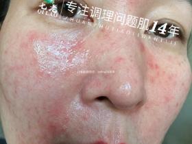 七老急性皮炎湿疹修护案例