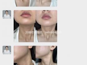 七老胶原水光6次的效果对比,对颈纹也很绝绝子
