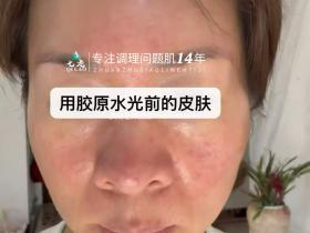 七老激素脸➕玫瑰痤疮➕脂皮修护案例