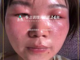 七老激素脸➕脂皮修护案例