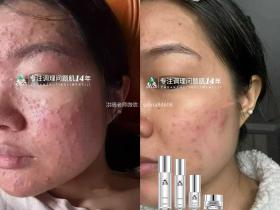 七老激素脸激素痘痘修护案例