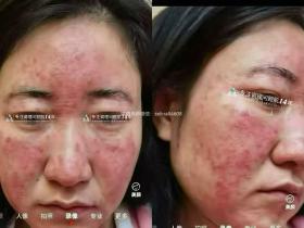 七老激素脸玫瑰痤疮修护案例