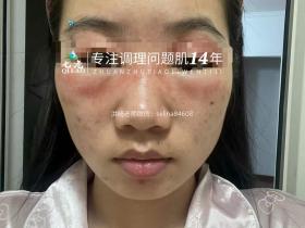 七老眼周反复过敏修护案例