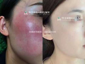 七老红烫肌修护案例