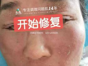 七老激素脸修护记录