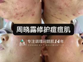 七老反复泛红长痘修护案例