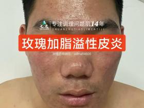 七老玫瑰痤疮➕脂溢性皮炎修护案例