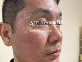七老十年顽固痘痘肌修护案例