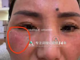七老激素脸发红发烫修护案例