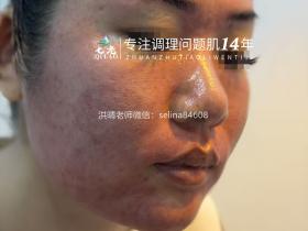 七老激素脸激素痘修护案例