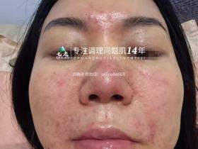 七老屏障受损油敏肌玫瑰痤疮修护案例