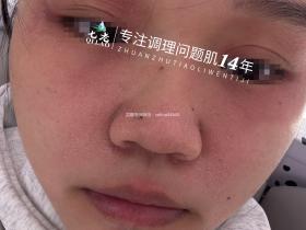 七老脂溢性皮炎修护案例