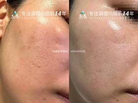七老油敏疹子修护案例好评反馈