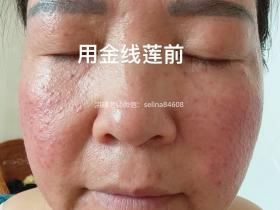 七老玫瑰痤疮用新品金线莲系列内测反馈