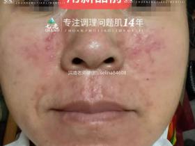 七老新品金线莲脂溢性皮炎五天反馈对比