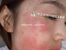 七老反复过敏红痒疹子修护案例