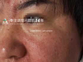 七老严重激素脸玫瑰皮➕脂皮修护案例