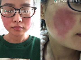 七老重度玫瑰大红脸修护案例