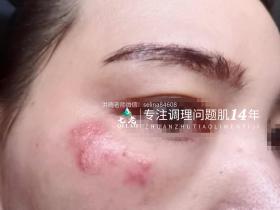 七老新品金线莲内测超级顽固痘痘➕脂皮17天反馈