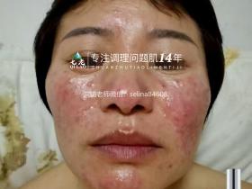 七老严重玫瑰脸玫瑰痤疮逆袭案例