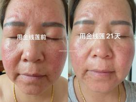七老新品金线莲修护玫瑰痤疮反馈