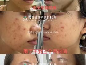 七老痘痘修护案例