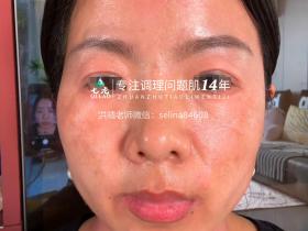 七老激素脸修护案例→全脸脖子红肿痒疹子爆皮