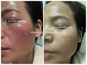 七老敏感泛红过敏依克多因霜修护案例