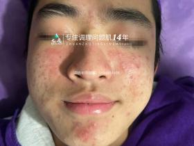 七老青春痘修护调理案例
