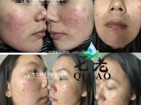 七老红烫痒疹子修护案例